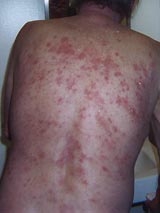 Chloramine Rash