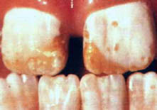 Fluorosis2